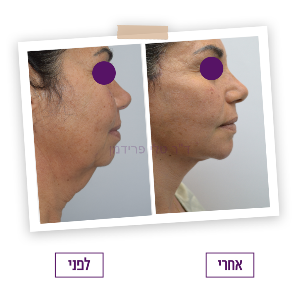 ניתוח מתיחת פנים לנשים